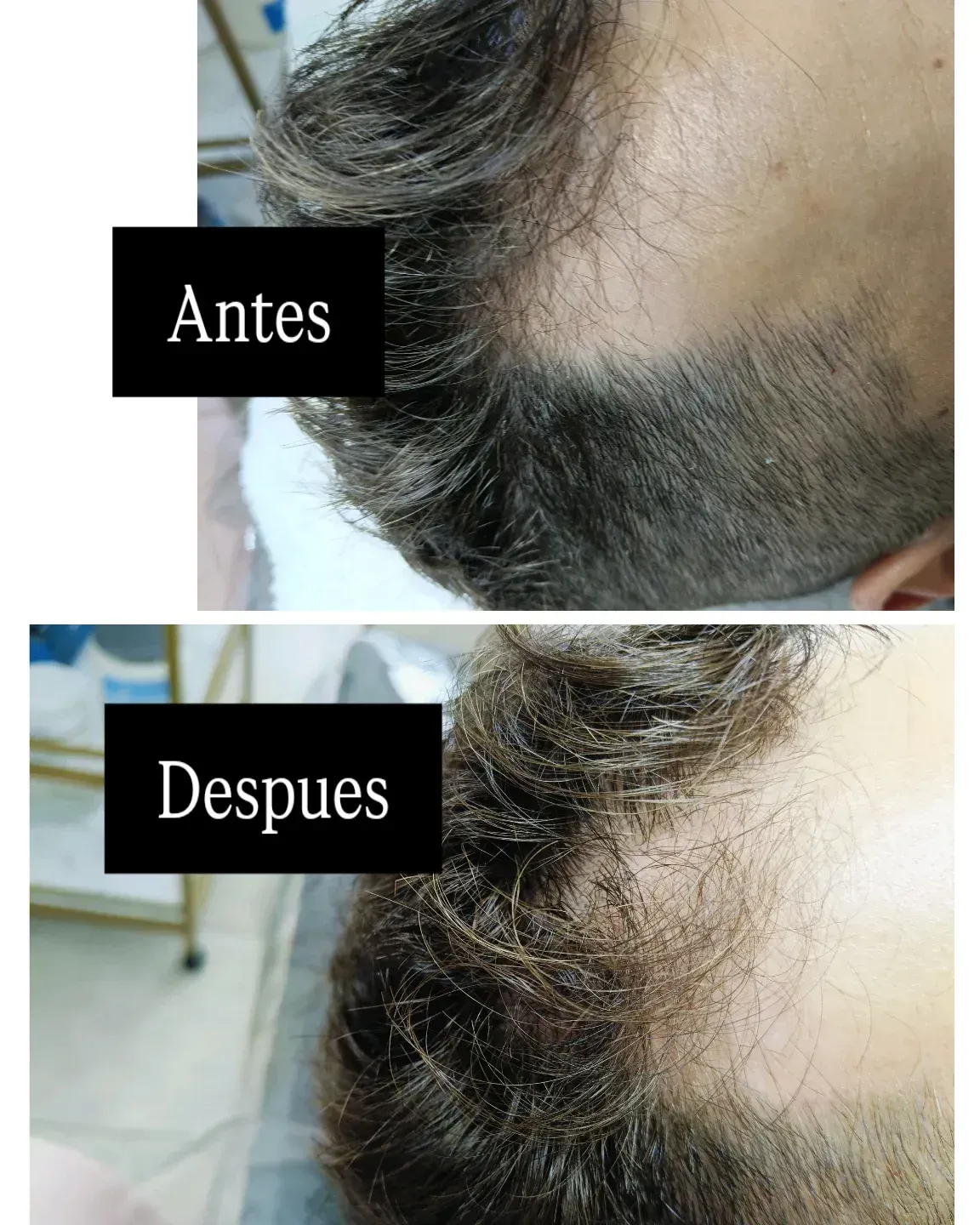 Comparación entre una línea de cabello en retroceso (