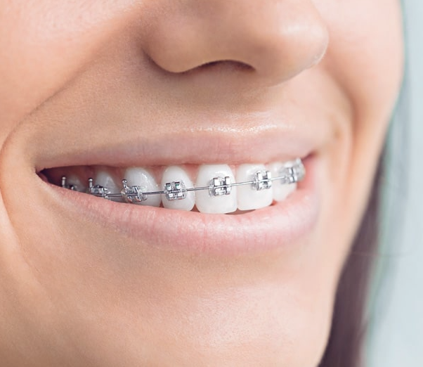Closeup of womans mouth with braces