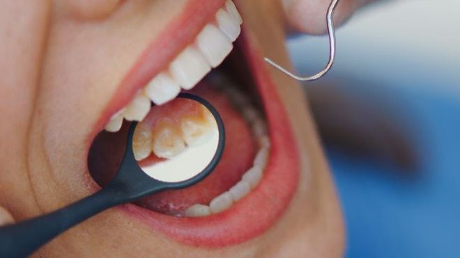 Una donna si sta facendo visitare i denti dal dentista.