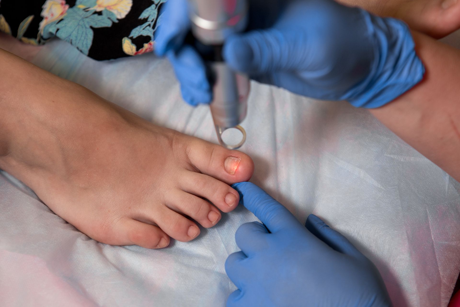 A laser device targets a toenail as a specialist performs treatment for a fungal nail condition.
