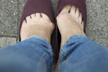 Bunion Treatments in Salem, OR