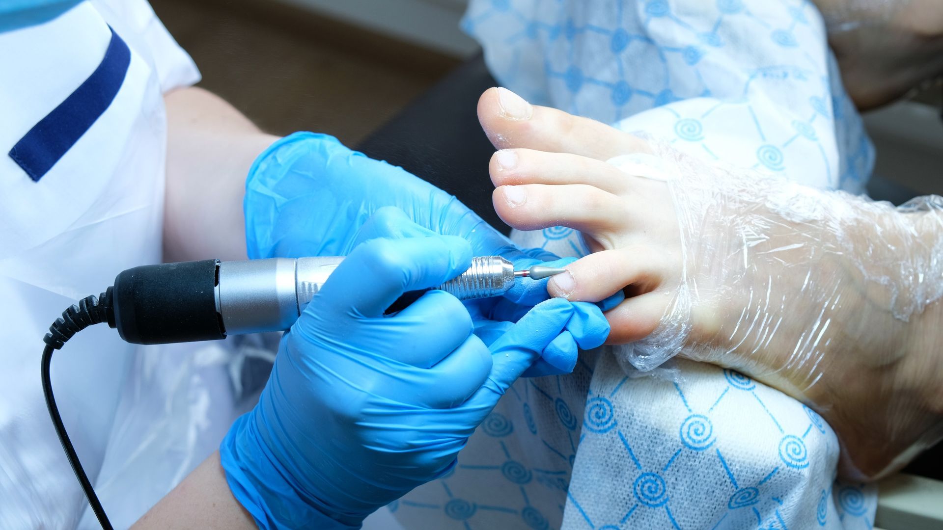 Toenail fungus treatment with foot laser at laser nail. Toenail fungus treatment with foot laser at laser nail.