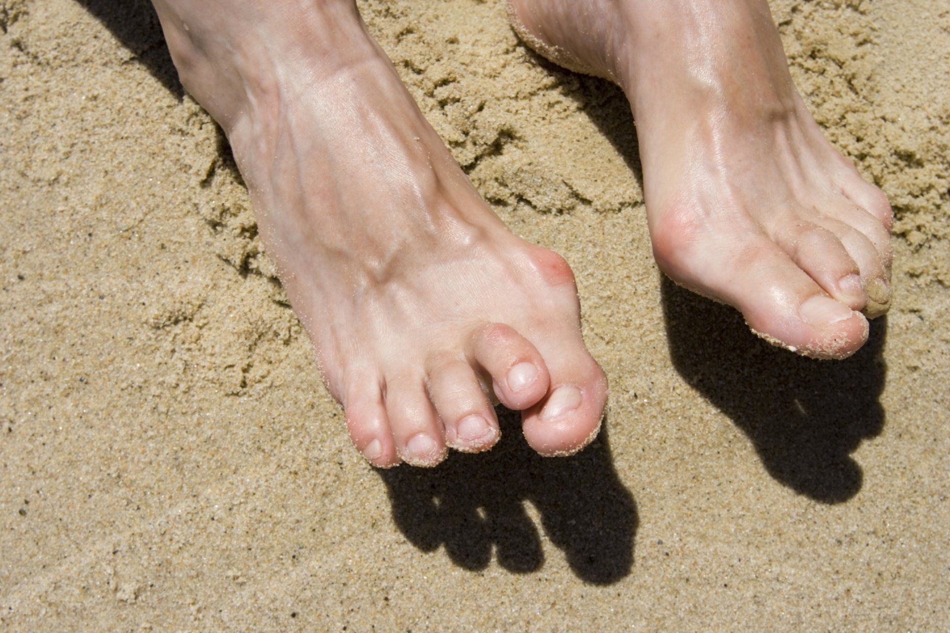 Hammertoe  Treatments—in Salem, OR