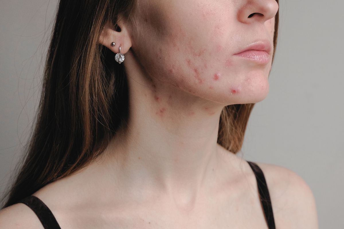 Entenda a acne, uma condição cutânea comum: suas origens, manifestações e soluções recomendadas para cuidar e proteger sua pele.