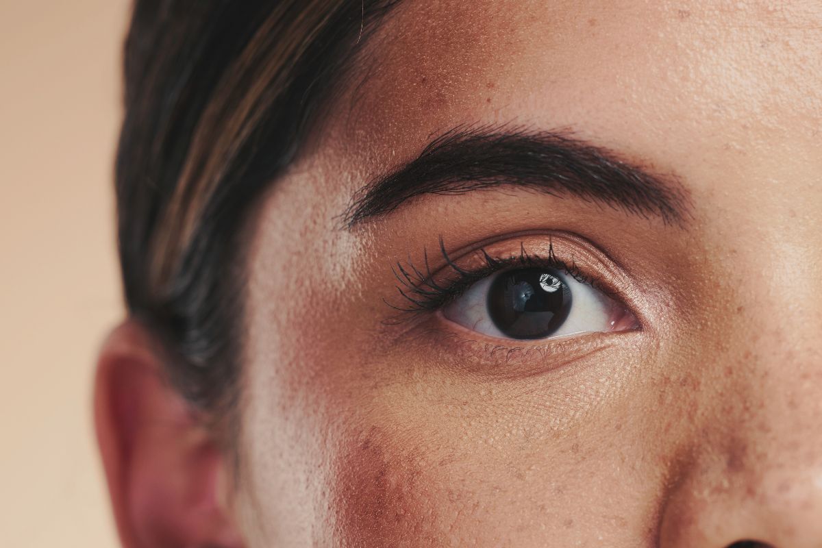 Aprofunde-se no melasma, um distúrbio pigmentar da pele, e descubra suas causas e os tratamentos recomendados para restaurar a uniformidade da pele.