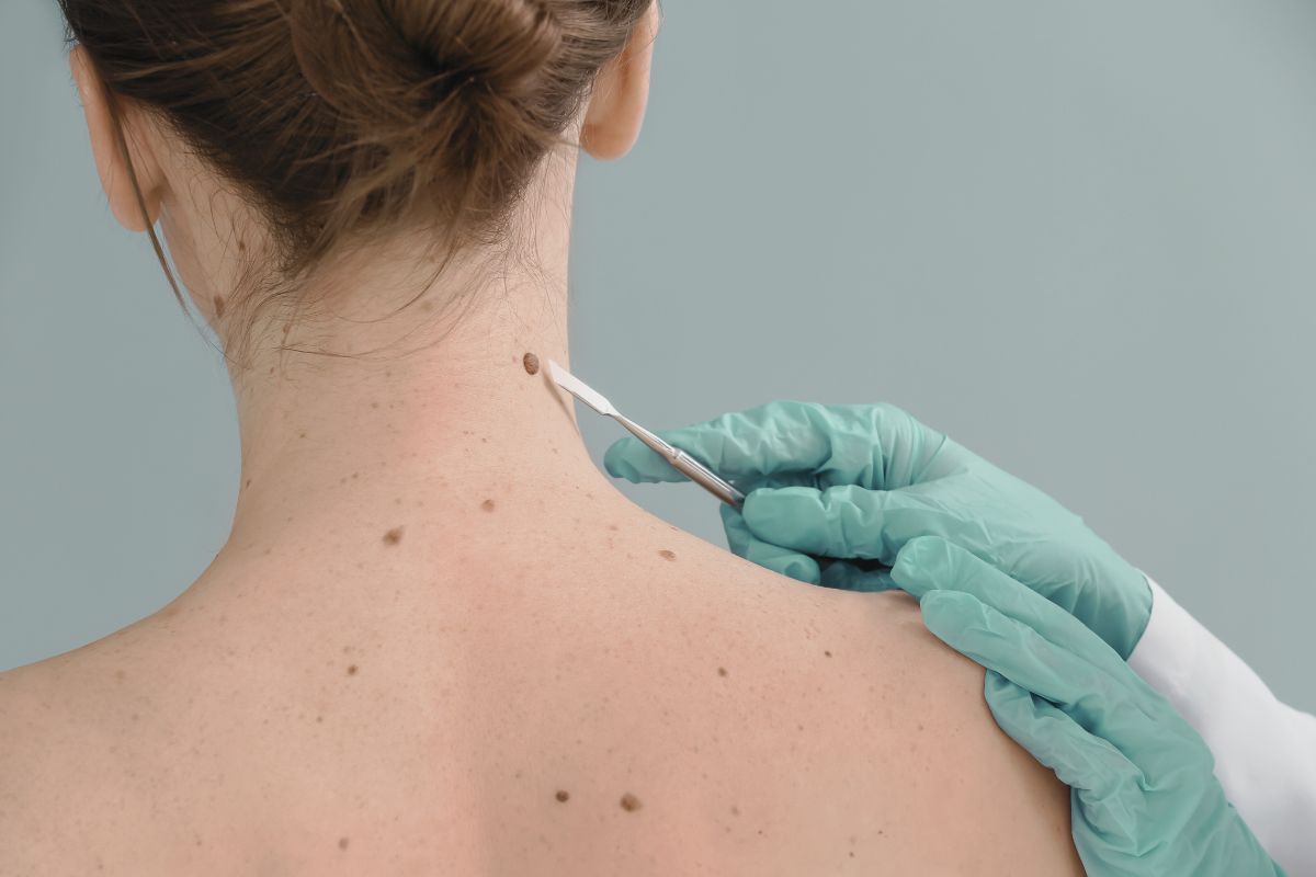 Descubra os motivos para a remoção de pintas, os métodos comuns de excisão e a importância da avaliação regular de pintas para prevenir o câncer de pele.