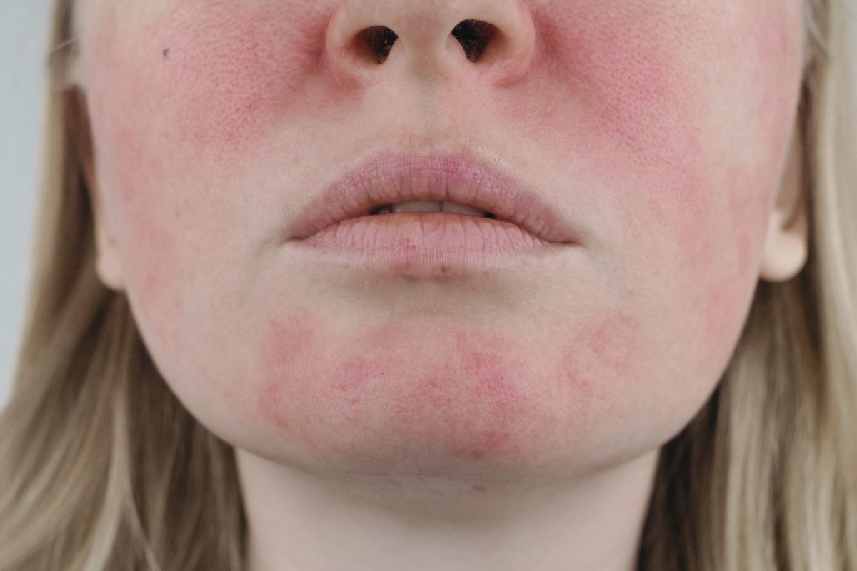 Entenda a rosácea, uma condição cutânea caracterizada por dilatação vascular, e explore suas causas, fatores de risco e tratamentos recomendados.