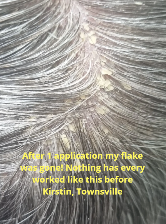 flaky scalp relief
