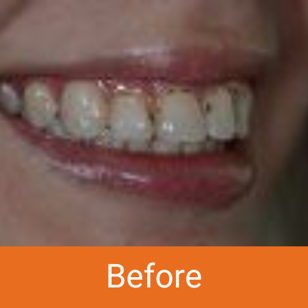 dirty teeth
