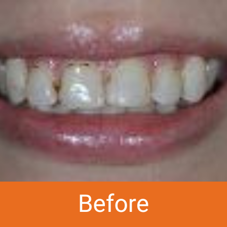not cleaned teeth