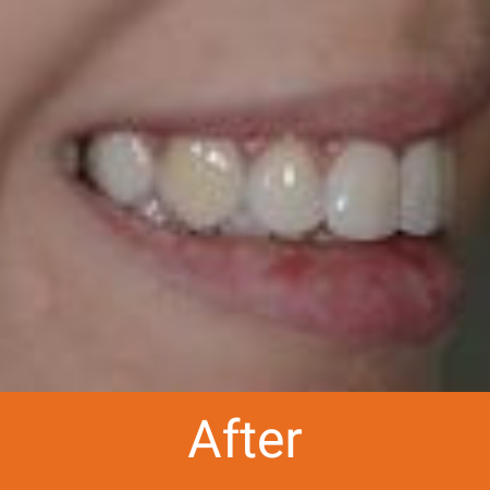 cleaned teeth