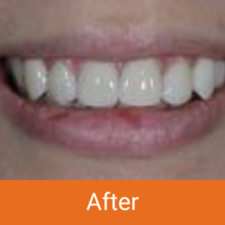 Girl smiling after smile makeover - Honeysuckle Dental, Newcastle