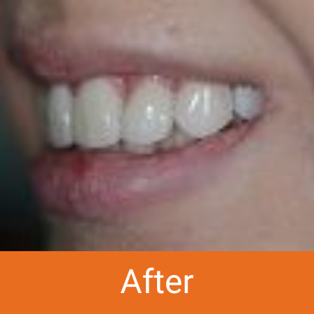 teeth whitened