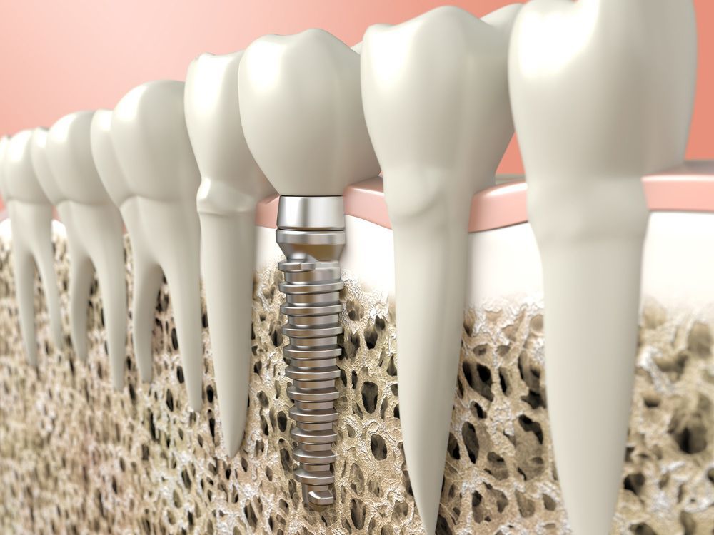 Close-up Of A Dental Implant — Dental Care in Newcastle, NSW