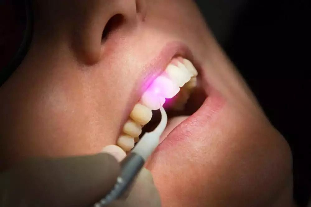 Teeth Whitening After Discoloration