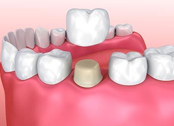 Crown for Tooth — Dunnellon, FL — Carolina Dentures and General Dentistry