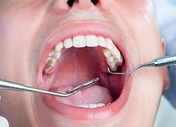 Dental Filling Procedure — Dunnellon, FL — Carolina Dentures and General Dentistry