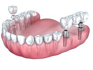 Dental Implant — Dunnellon, FL — Carolina Dentures and General Dentistry