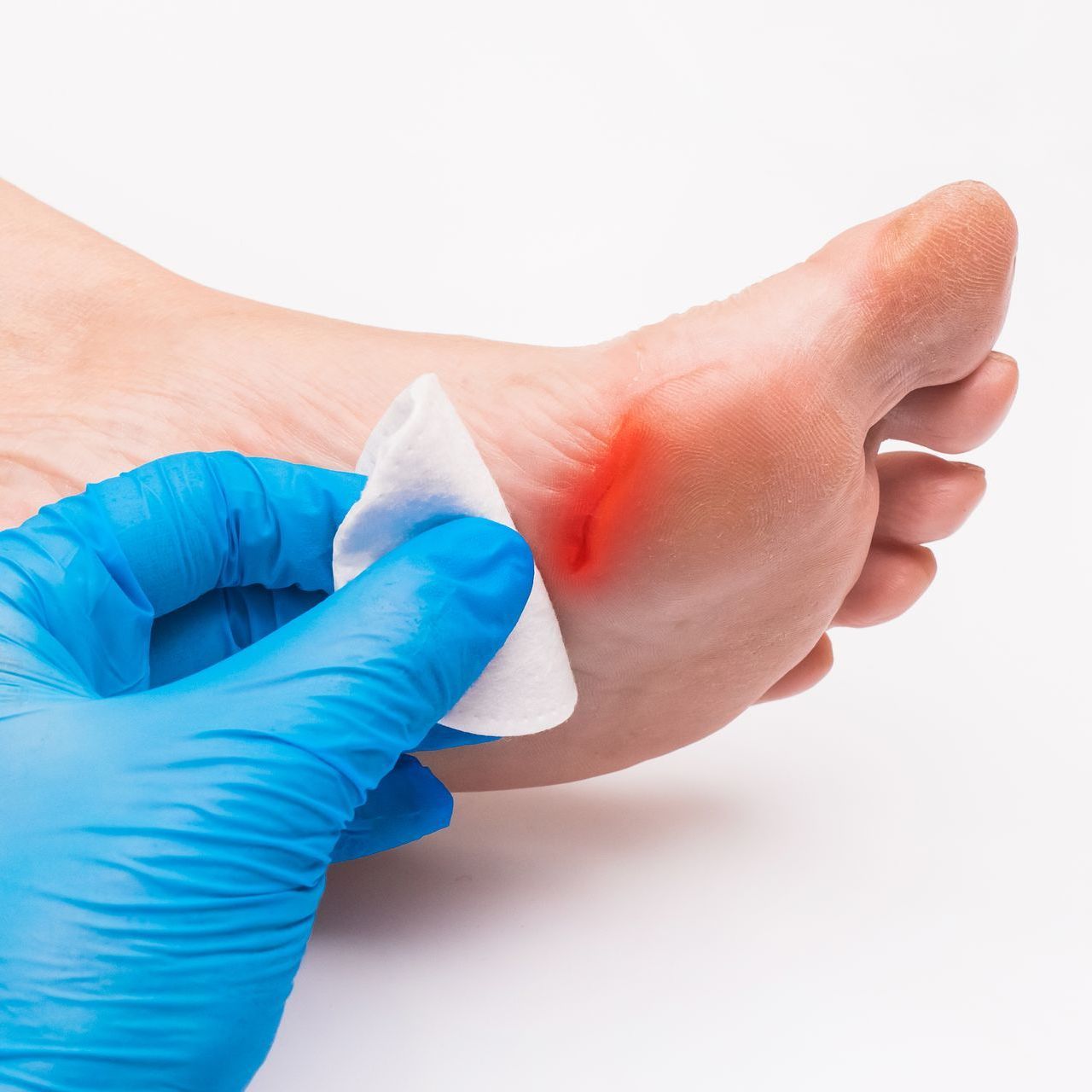 A person wearing blue gloves is examining a person 's foot.