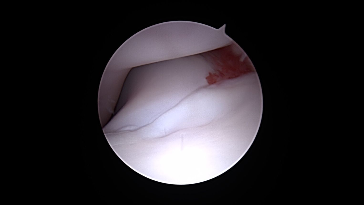 Vue arthroscopique de l'intérieur d'une articulation, montrant du cartilage blanc et des tissus rougeâtres.