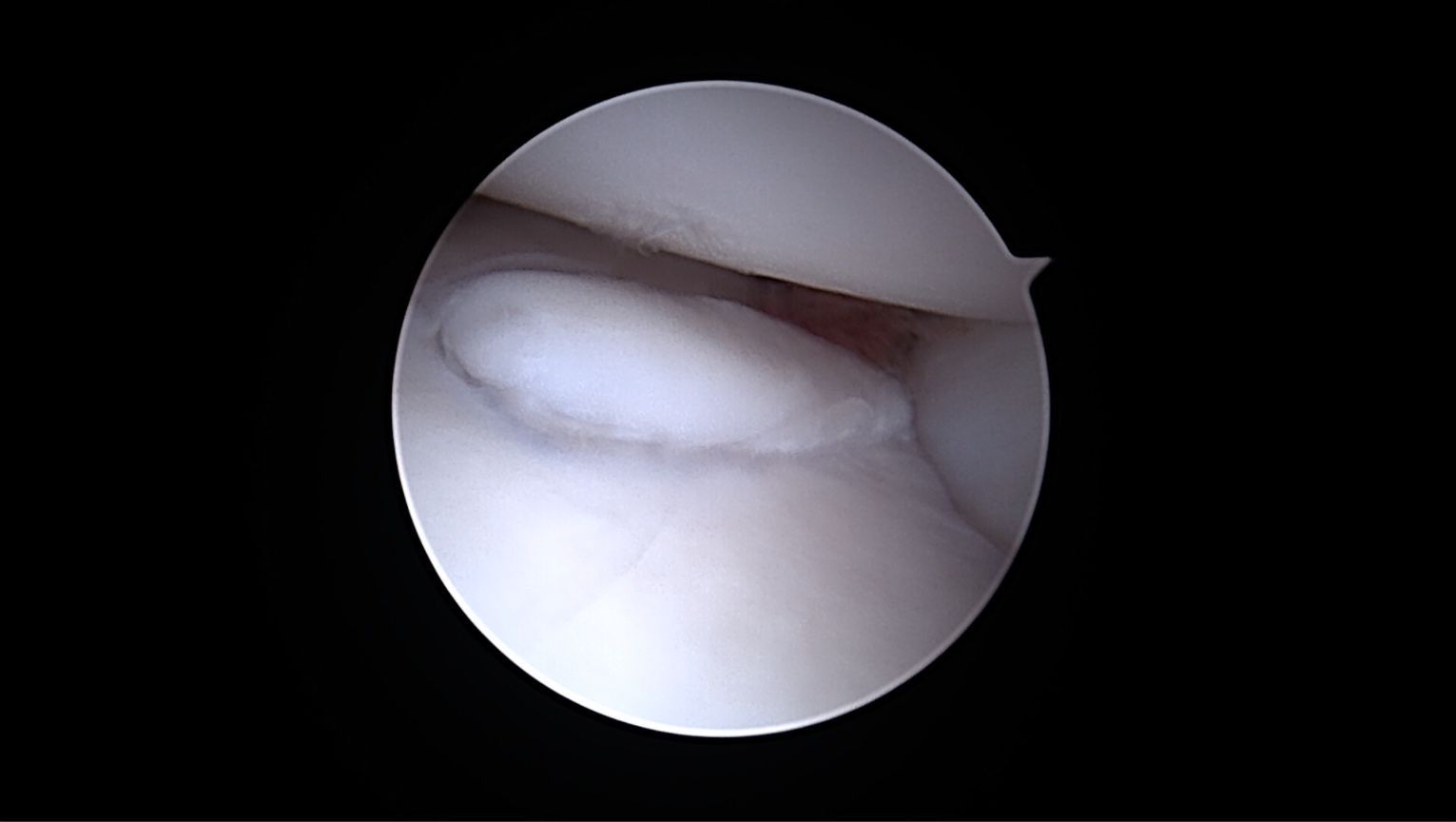 Vue arthroscopique d'une articulation du genou ; cartilage blanc et structures environnantes visibles.