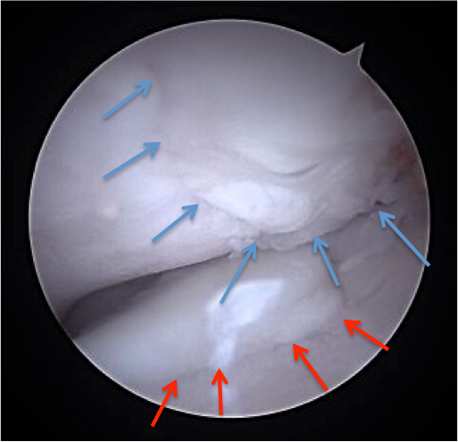 Vue arthroscopique de l'intérieur du genou ; les flèches bleues indiquent un tissu lisse, les flèches rouges une surface plus rugueuse.