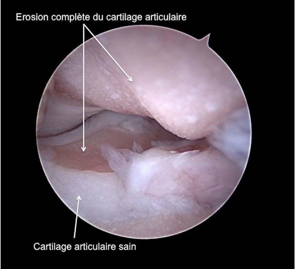 Vue arthroscopique d'une articulation du genou montrant une érosion complète du cartilage articulaire, avec du cartilage sain visible.