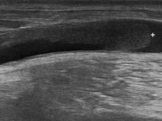L'échographie montre une zone sombre remplie de liquide avec une croix blanche.