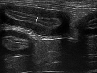 Échographie montrant les différentes couches de l'intestin, les mesures étant indiquées par des croix blanches.