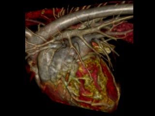 Représentation 3D par tomodensitométrie d'un cœur humain et de ses principaux vaisseaux sanguins, dans des tons de rouge, de brun et d'or.