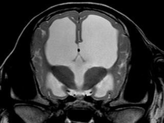 Coupe transversale par IRM d'un cerveau présentant des ventricules dilatés.