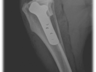 Radiographie d'un os de la jambe montrant une plaque métallique et des vis utilisées pour réparer une fracture.