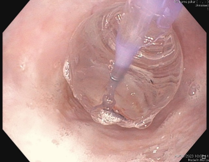 Vue endoscopique d'un ballonnet œsophagien distendu contenant un cathéter. La muqueuse de l'œsophage l'entoure.