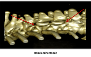 Scanner 3D de la colonne vertébrale d'un chien avec des flèches rouges pointant vers les zones où une hémilaminectomie a été pratiquée.