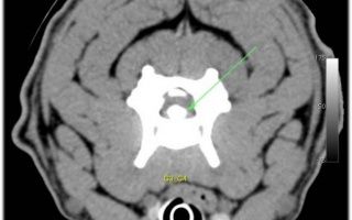 Scanner CT en coupe transversale de la colonne cervicale avec une flèche verte pointant vers un problème possible au niveau du canal rachidien.