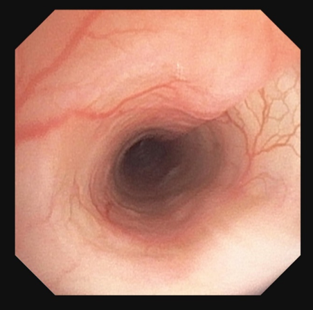 Vue endoscopique de l'œsophage : un tube rosé avec des vaisseaux sanguins visibles et une ouverture sombre.