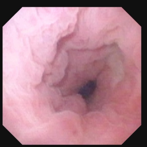 Vue endoscopique d'un œsophage rose et plissé avec un centre sombre.
