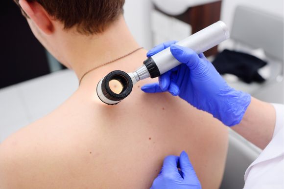 Analisi preventiva per melanoma