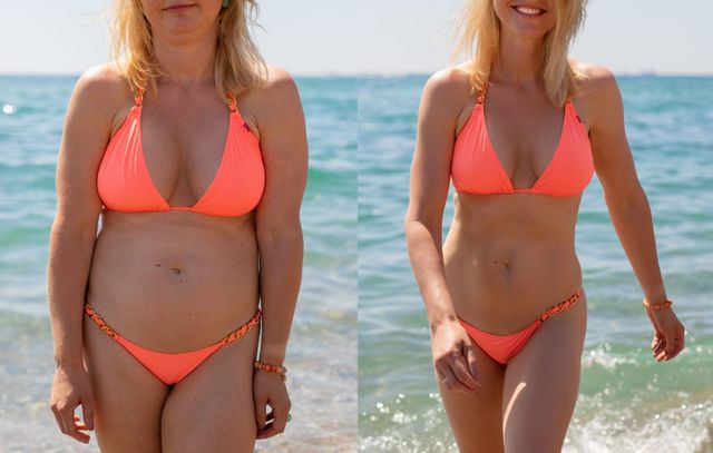 Dr. Sandra McGill - Liposuction can improve your silhouette in many  different ways. By smoothing love handles, narrowing the waist and reducing  the fat along the bra line, it creates a more