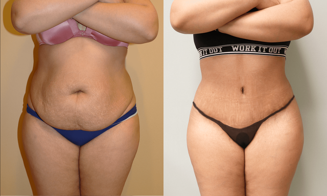 Tummy Tuck Surgery by Board-Certified Plastic Surgeon, Dr. Ashley