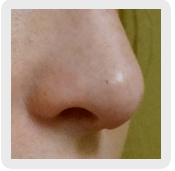 indianapolis rhinoplasty gallery example 4 by Dr. Ashley Robey