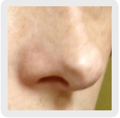 indianapolis rhinoplasty gallery example 3 by Dr. Ashley Robey