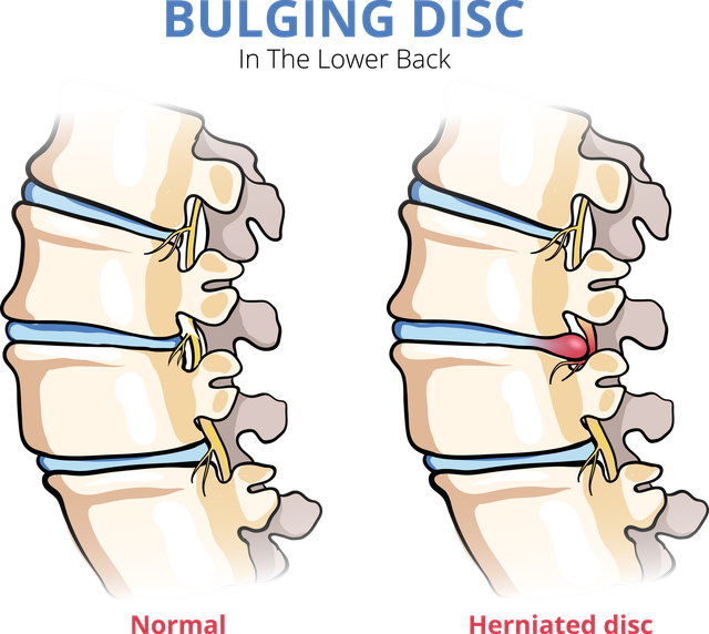 Joint Injection Bulging Disk What Is An Epidural Injection For Bulging Disc