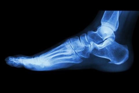 Foot Xray - foot surgery in Westborough, MA