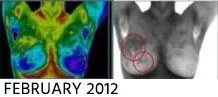 Breast Cancer Screening
