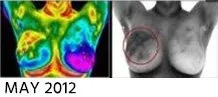 Breast Cancer Screening