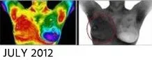 Breast Cancer Screening