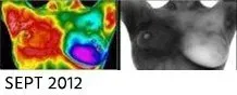 Breast Cancer Screening