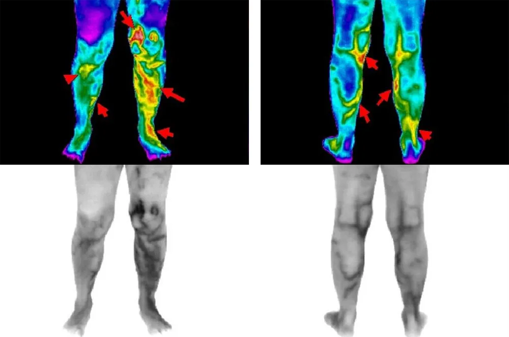 DVT Viewed in Left Leg Indicated by Increased Varicosities