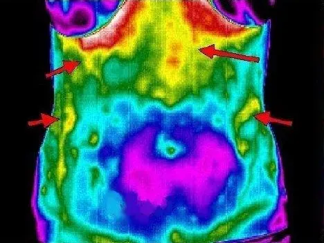 Gastroesophageal reflux disease (GERD)
